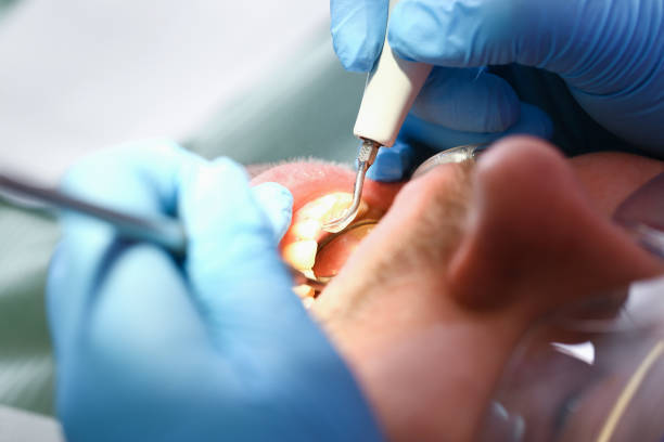 Best Emergency Dental Care for Abscessed Tooth in Santa Ana, CA